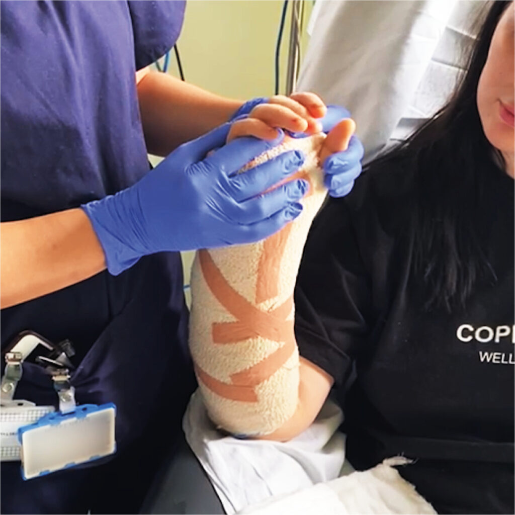 An image of Becca's hand and arm covered in bandages, as a clinician assesses the movement available in her fingers.